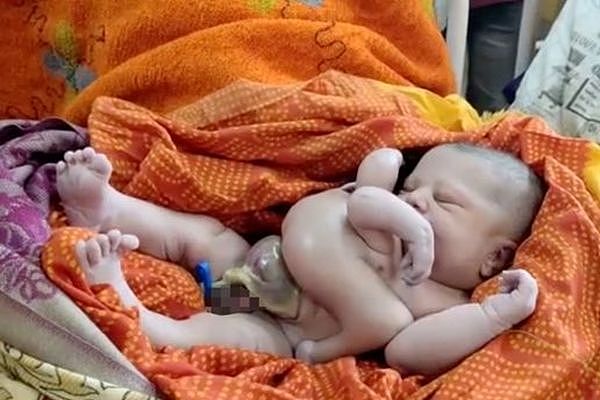 ▲▼ 印度孕妇生下4手4脚婴儿。 （图／翻摄自Twitter）
