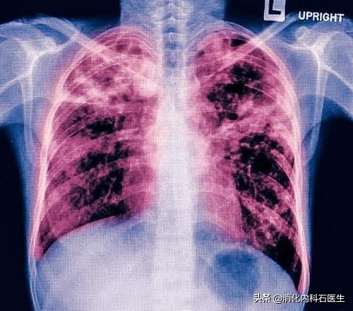 男子反复咳嗽4年，肺癌放疗3次，找到病灶时医生气得只想爆粗口