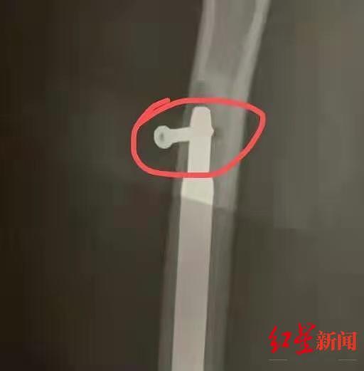 11月17日X光片显示，钉子脱落。受访者供图.jpg