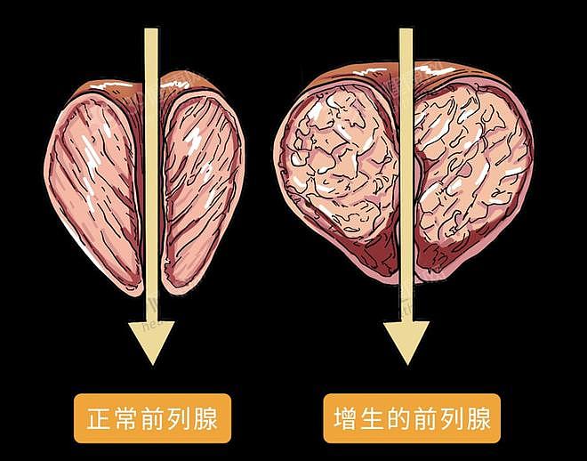 【健康】提醒男性：30岁后，想要远离“前列腺增生”，这3个行为要少做（组图） - 13