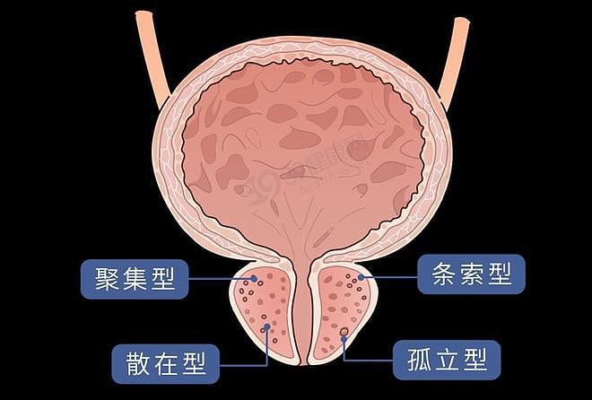 【健康】医生提醒：男性不想被前列腺钙化“盯”上，这5件习惯要反思（组图） - 3