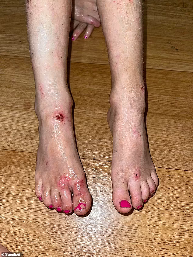 天气炎热潮湿小心皮肤病！澳女童患上湿疹瘙痒不已，手脚渗出脓血（组图） - 3