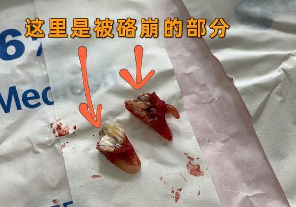 北京一女子被一根薯条崩碎牙，店方承诺赔付后又翻脸：诉讼解决（组图） - 2