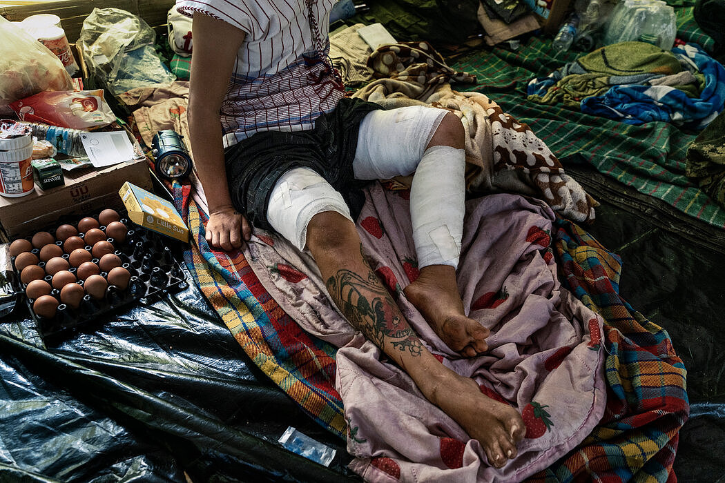 吴孟吉在与军政府的战斗中腿部中弹，在克伦邦的一个偏远民兵营地进行了两次手术。