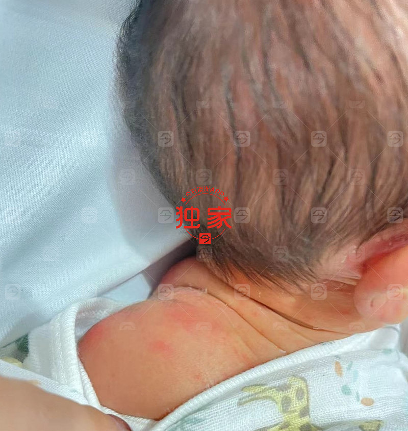 悉尼华人宝妈哺乳期喝中药，疑致新生儿浑身起红疹！中医师：从医38年第一次（组图） - 4