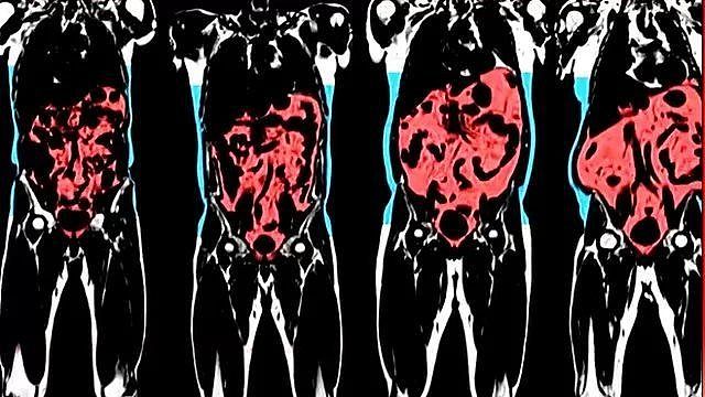 内脏脂肪多不益健康