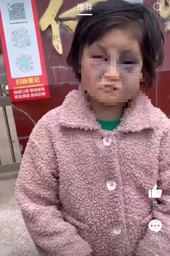 女童被打成熊猫眼，当地通报：系精神残疾母亲所打，女孩已出院（图） - 1