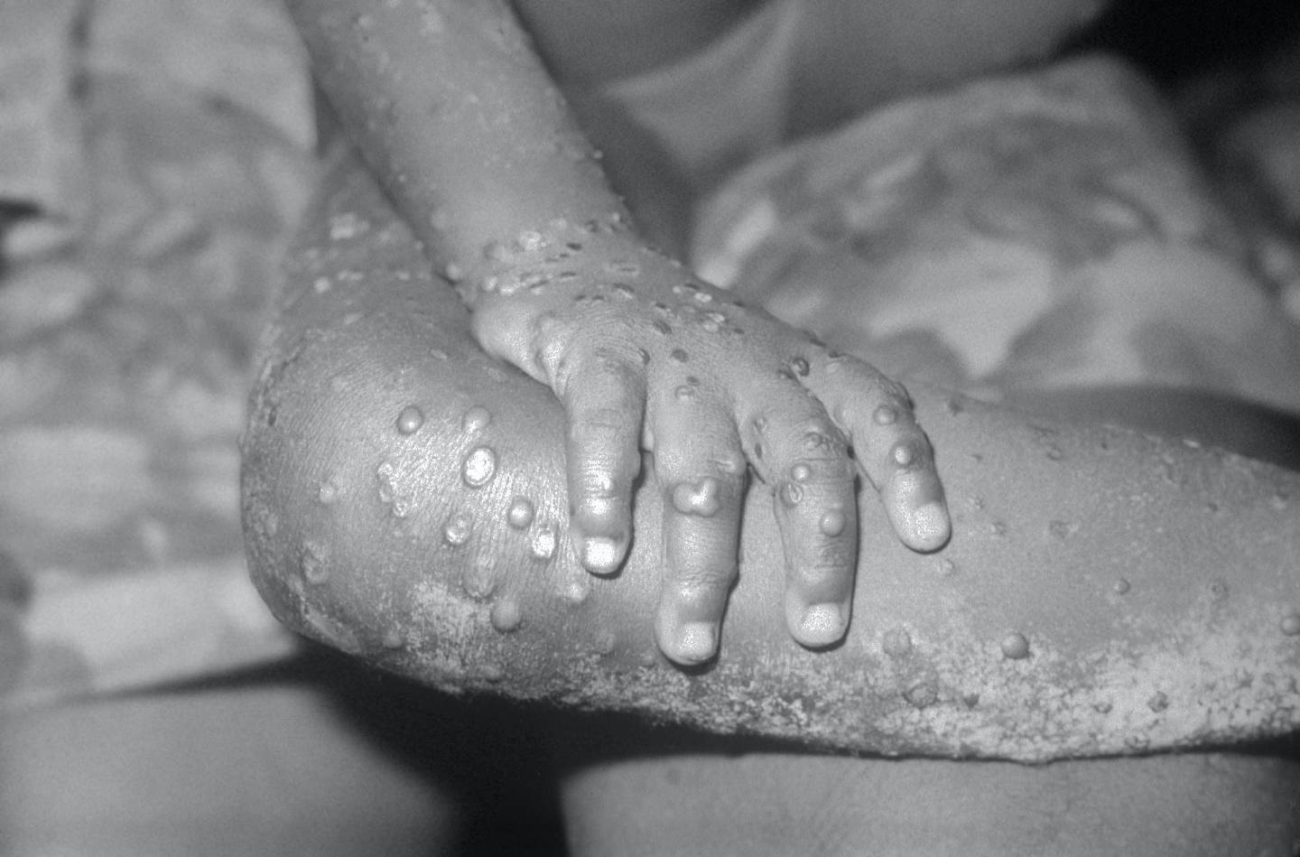 美国疾病控制和预防中心在1971年公布的照片，显示利比利亚一名女孩的手及腿部出现猴痘。 （Getty Images）