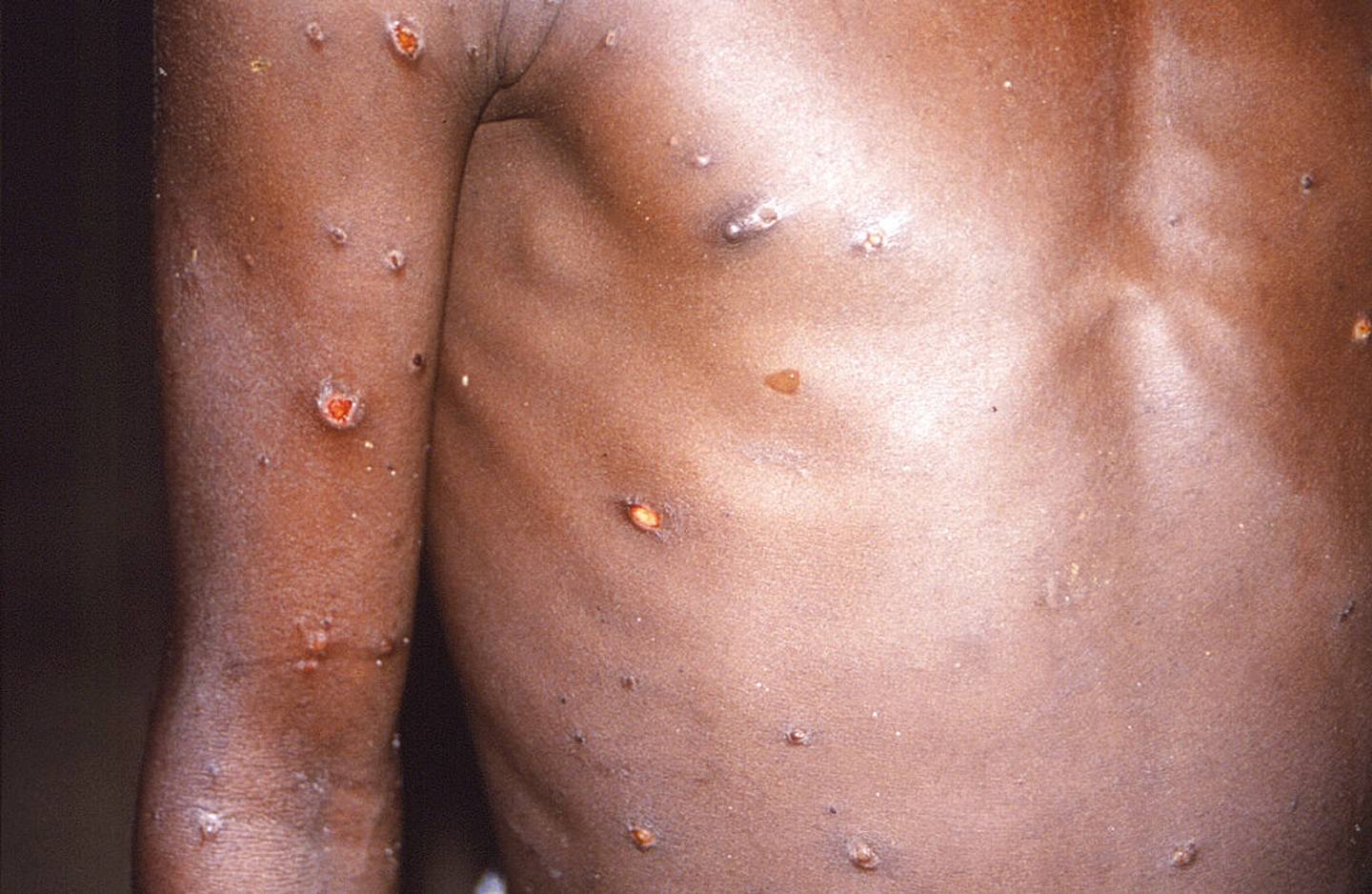 猴痘：图为美国疾病控制和预防中心（CDC）提供的一张摄于1997年的照片，相中人是猴痘病人，此人右臂及身躯有病变的情况。 （AP）