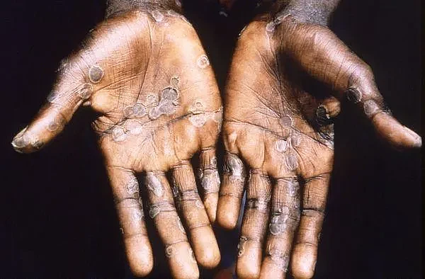 非洲流行病猴痘（Monkeypox）近期已逐渐扩大至欧洲及北美国家。 （图／路透社）