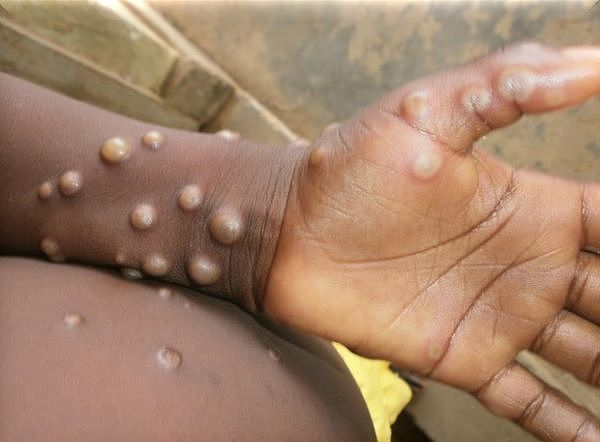 ▲▼猴痘。 （图／翻摄自WHO／Nigeria Centre for Disease Control）