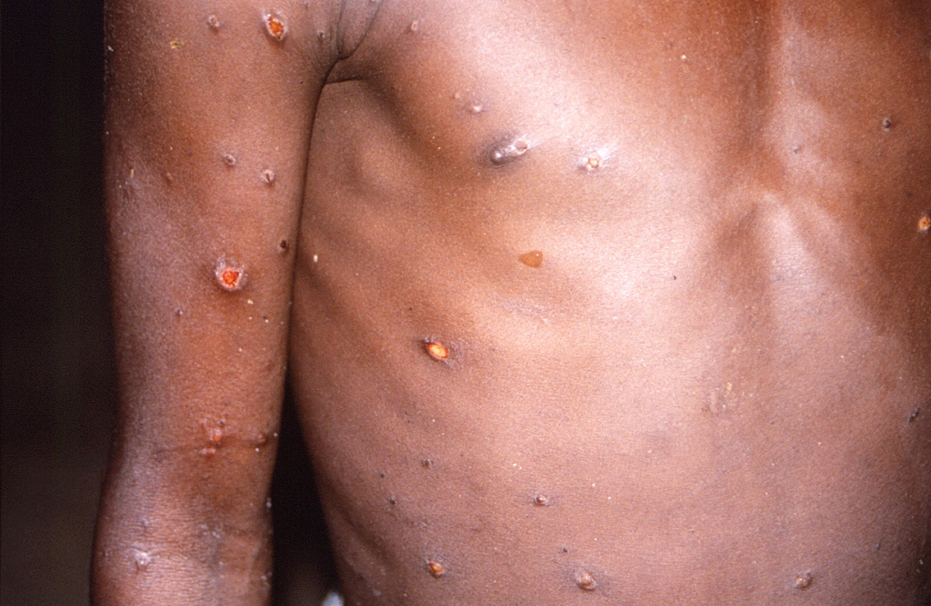 猴痘造成的皮疹接着会转为脓疱并产生剧痛，脓疱破裂流出液体与结痂的皮疹都有高传染性。 （图／路透）