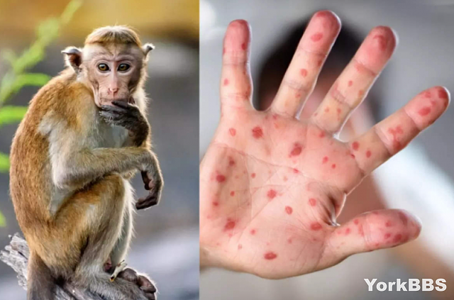 猴痘疫情爆发两种人群高危，恐成永久地方流行病（组图） - 2