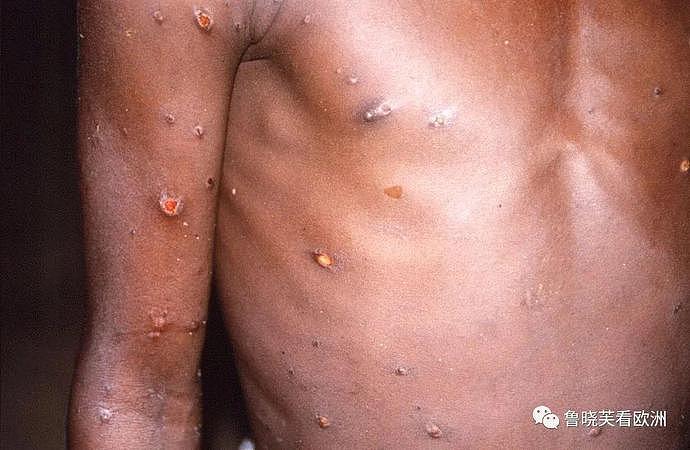 猛男跟10男发生性关系以后染病，不知道传染源是谁！最新研究：猴痘可通过空气传播，类似新冠病毒（组图） - 3
