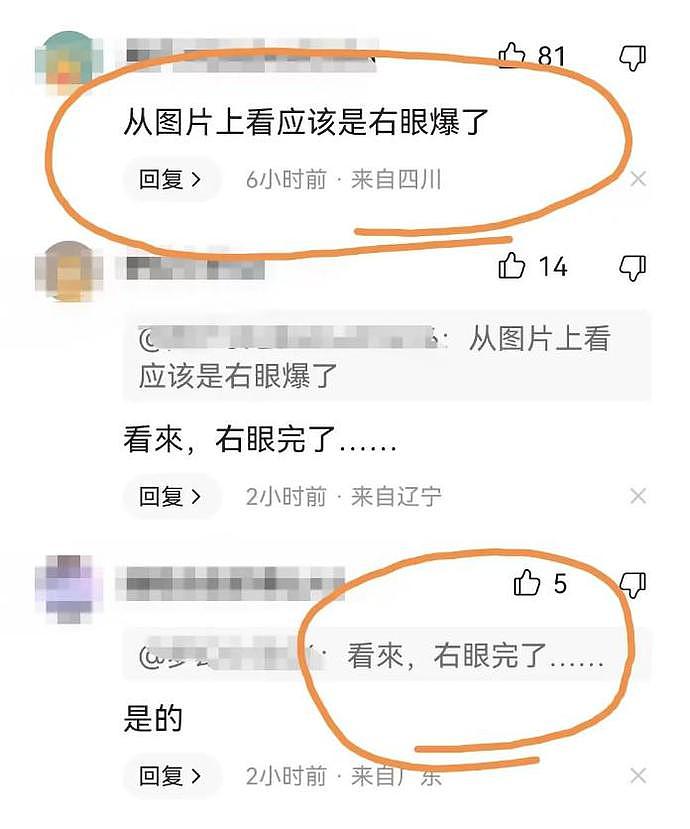 唐山打人案另一女孩伤情照片曝光！右眼疑被打爆，更痛心在后面，网友：多处骨头估计全碎了（视频/组图） - 3