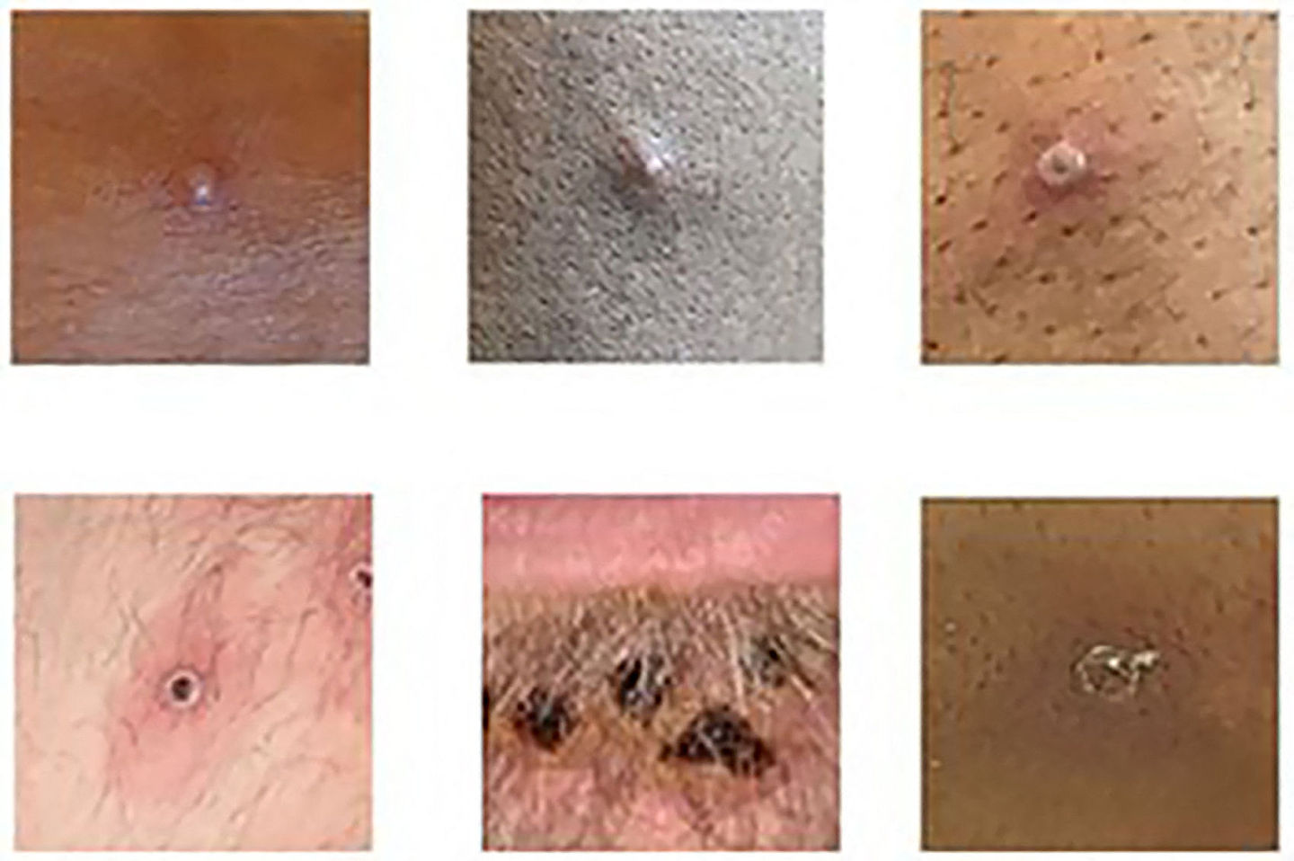 ▲▼英国卫生安全局发布一张图片，展示了一组猴痘皮疹病变的拼贴图。 （图／CFP）