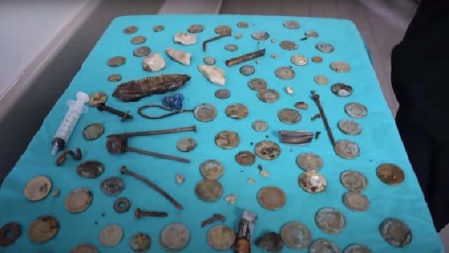 医师从男子的胃中取出233个小物件，包括1里拉硬币、电池、磁铁、钉子、玻璃碎片、石头与螺丝等。 翻摄《都市报》