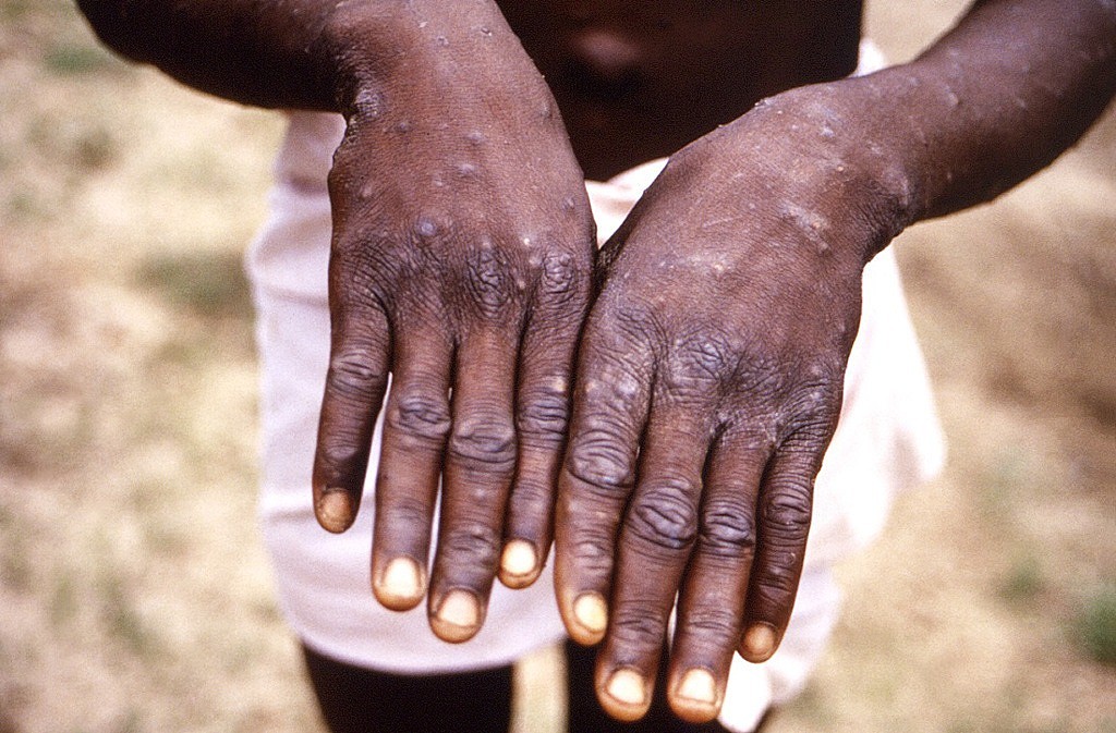 猴痘在今年有扩散迹象，全球各国纷纷出现病例。(图／美国CDC)