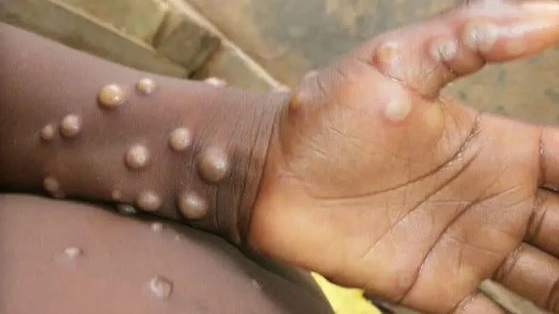 我国出现首例猴痘境外移入确诊案例。 （图／翻摄自WHO网页who.int）
