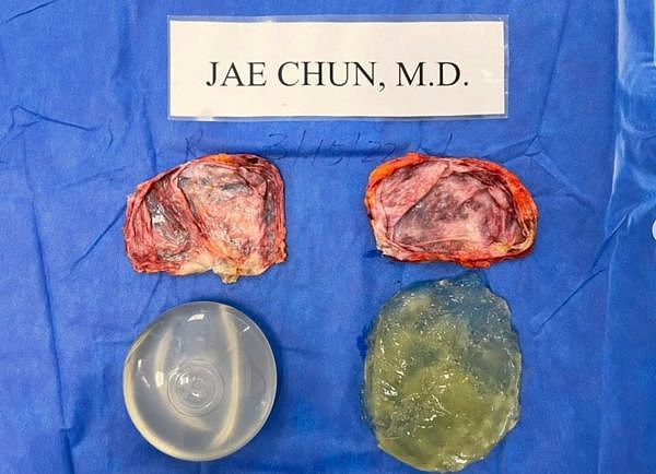 ▲▼整形外科医师Jae Chun也经常在IG分享取出乳房植入物的手术案例。 图为已植入18年的肌肉下矽胶植入物完整摘除照，尽管单侧破裂但并未渗出荚膜。 （图／翻摄自Instagram／jchunmd1）