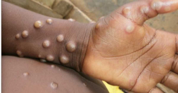 世界第一例猴痘案例出现在1970年出现，当时大多是动物传染给人类，但如今已经演变成人传人，而且传播力似乎有加快的趋势。 （图／取自WHO）