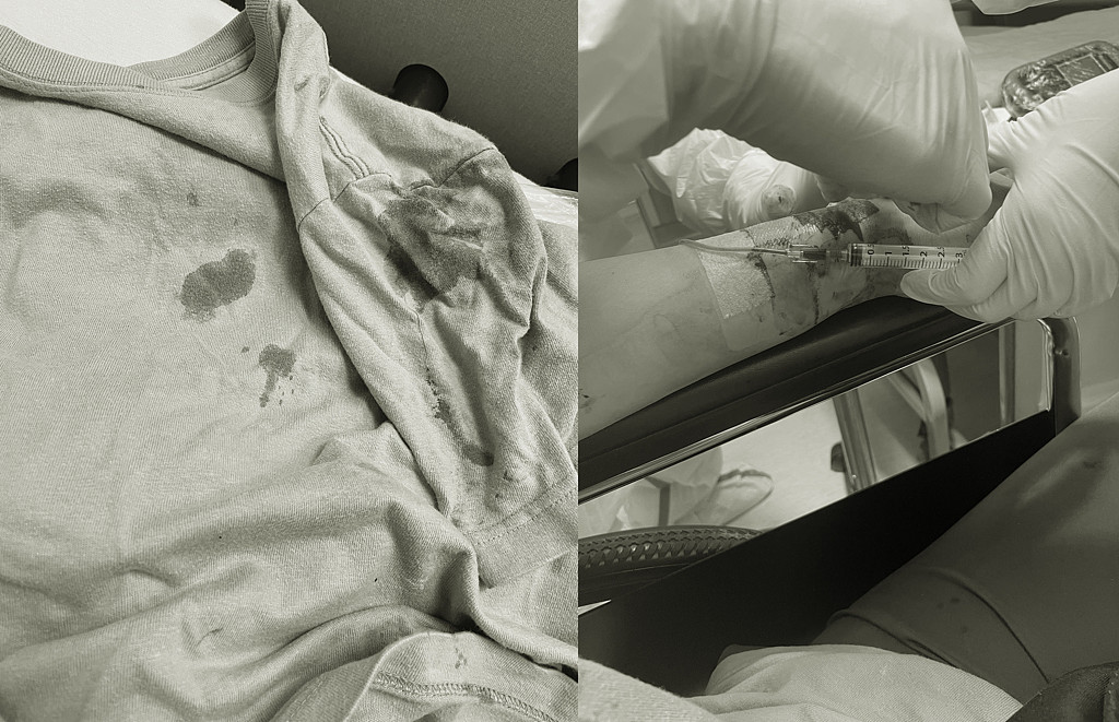 一名女网友本月4日确诊入住医院，住院第2日就遭同病房的阿姨扯下点滴、无故暴打，她的衣服与双手全沾满鲜血。 图片经变色处理。 （翻摄自Dcard）