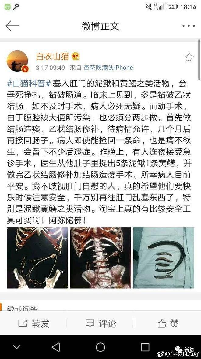 头皮发麻！网曝一女子为求刺激将黄鳝塞入身体，医生取出时感叹：还是活的（视频/组图） - 14