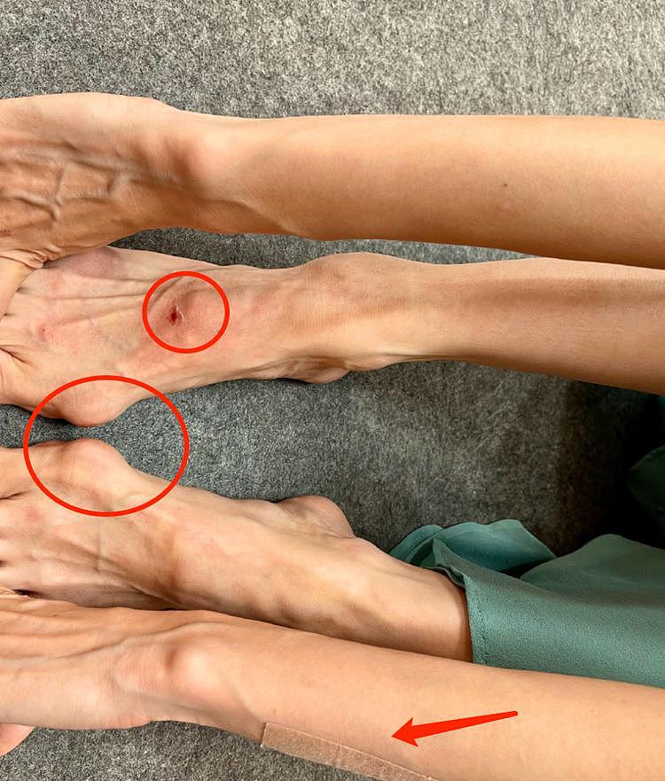 首席舞者朱洁静晒照，手脚青筋异常凸起，脚部严重变形（组图） - 2