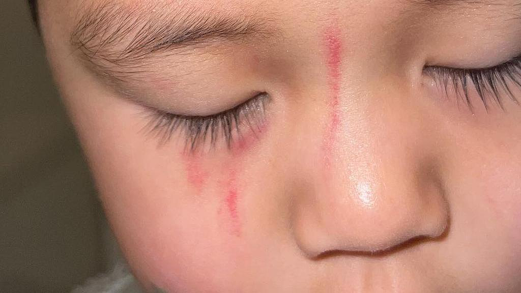 “只是在玩闹”？澳男童托儿中心被小朋友咬伤，脸上布满抓痕！家长怒批机构“不负责”（组图） - 2