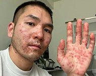 华裔小哥感染猴痘出现罕见症状，眼睛长疹渗液险失明