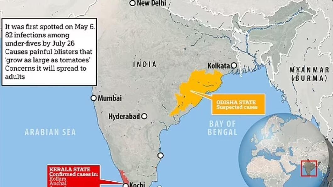 「番茄流感」最初于印度南部的喀拉拉邦（Kerala）现踪，之后在东部的奥里萨邦（Odisha）也出现疑似病例。 （图／翻摄自每日邮报） 神秘疾病「番茄流感」现踪印度2个月已58童亡