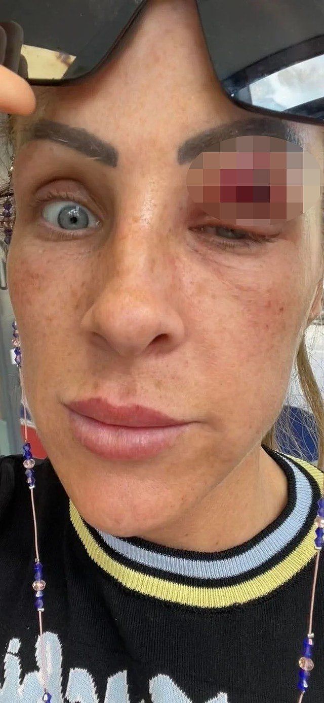 英國女子愛德華茲上月22日一起床就發現左眼皮有一處紅點，起初並不在意，但紅點不過1日就已經變成大膿包。愛德華茲連眼都睜不開，整個頭部都無時無刻地劇痛。（「Louise Edwards」facebook圖片／聯合新聞網後製）