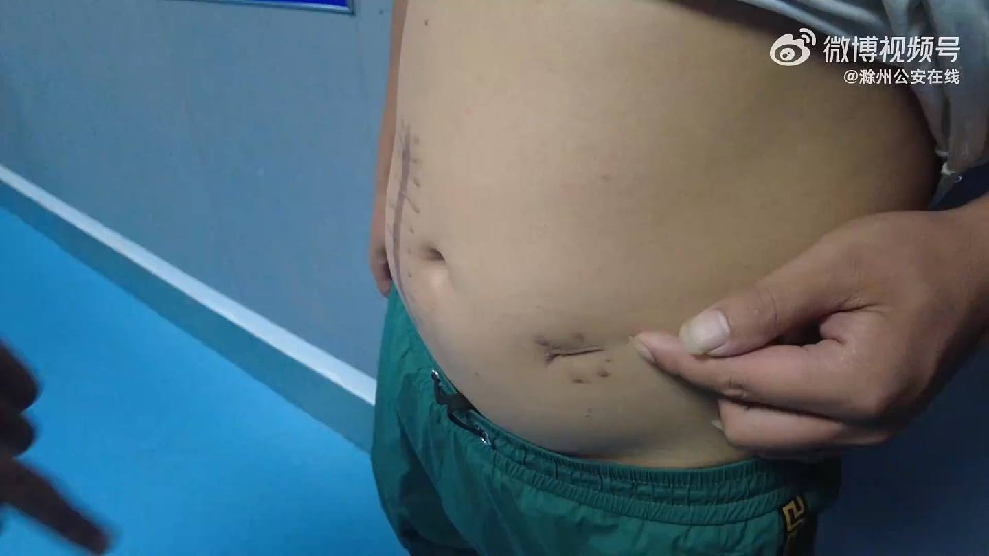 刘男展示伤势，他指诈骗集团老板朝他腹部捅了两刀，一刀捅穿了胃，一到捅伤了肠子。 （影片截图）