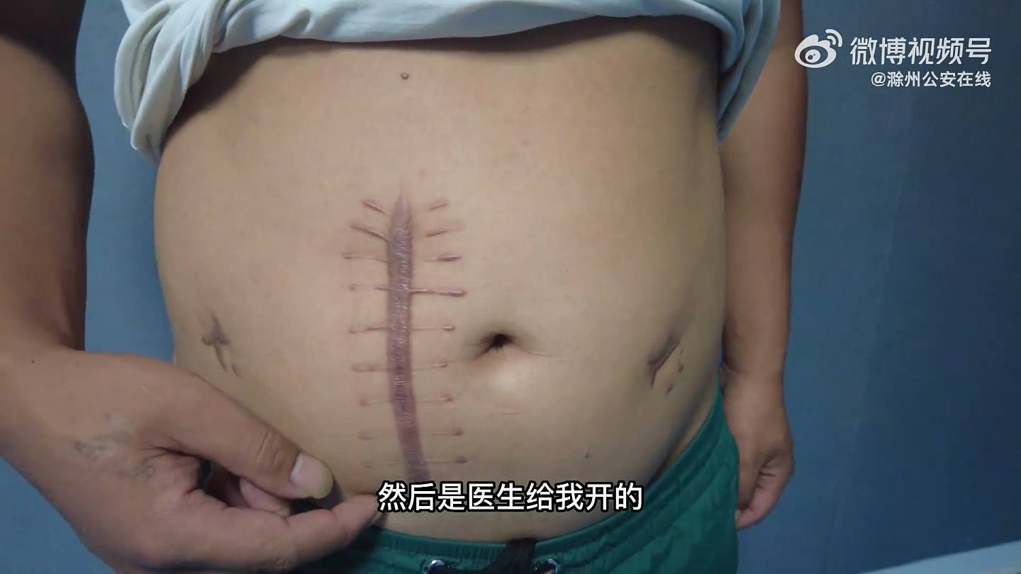 刘男指肚中间的大疤痕是缅甸当地医生为他开刀做手术后留下的。 （影片截图）