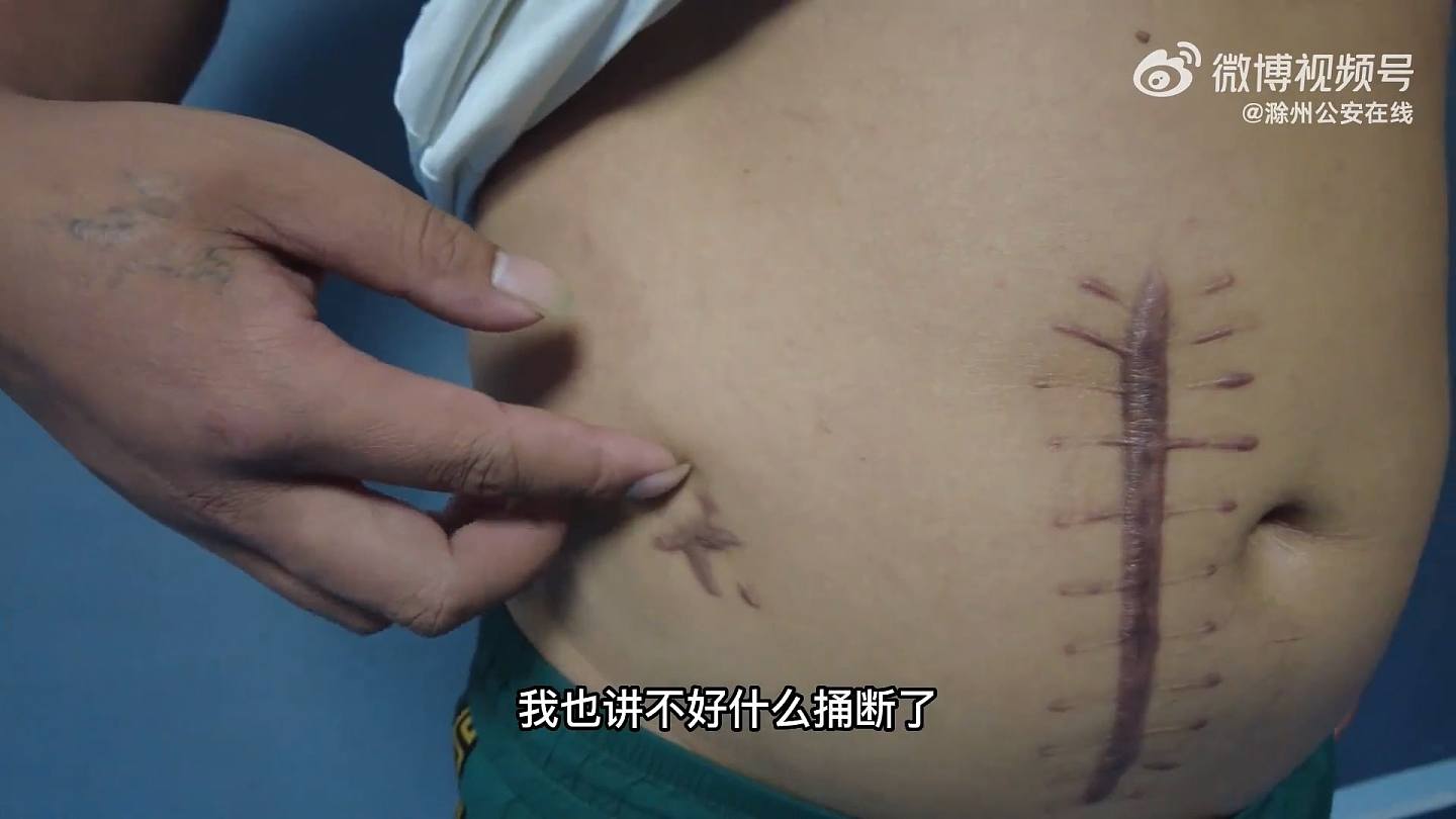 刘男展示伤势，他指诈骗集团老板朝他腹部捅了两刀，一刀捅穿了胃，一到捅伤了肠子。 （影片截图）