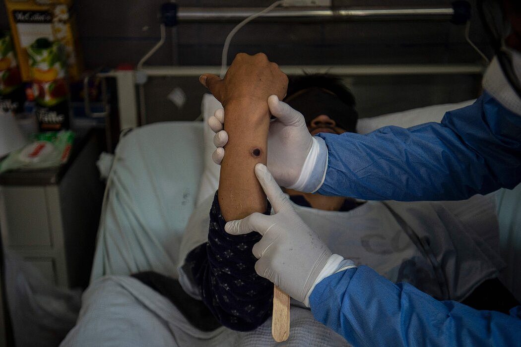 秘鲁利马市一家医院内一名出现猴痘溃疡的患者。
