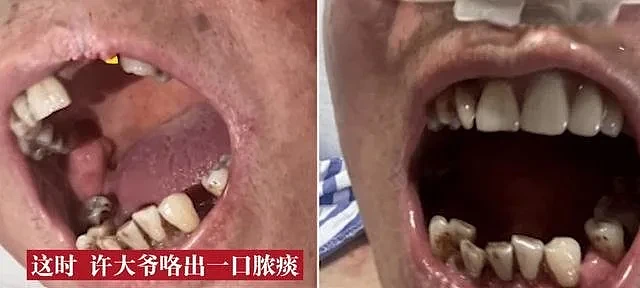 78岁老人30年不刷牙，致肺部感染（组图） - 3