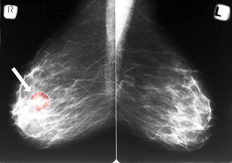 【健康】姚贝娜查出乳腺癌时是早期，化疗后已痊愈，为何人最后还是没了（组图） - 5