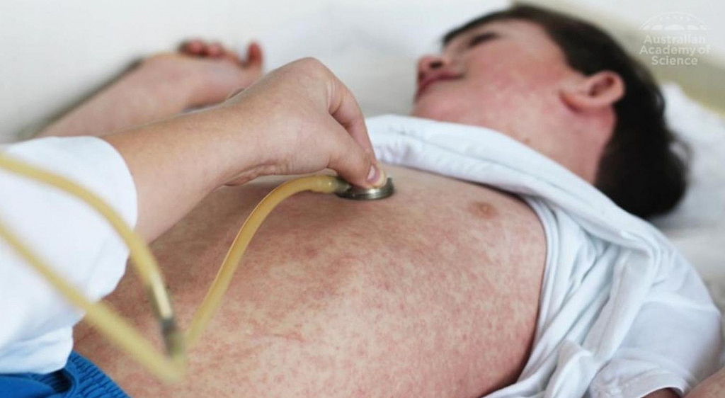 新州男去亚洲旅行感染麻疹，在社区活动时具备传染性！当局发出警告（组图） - 2