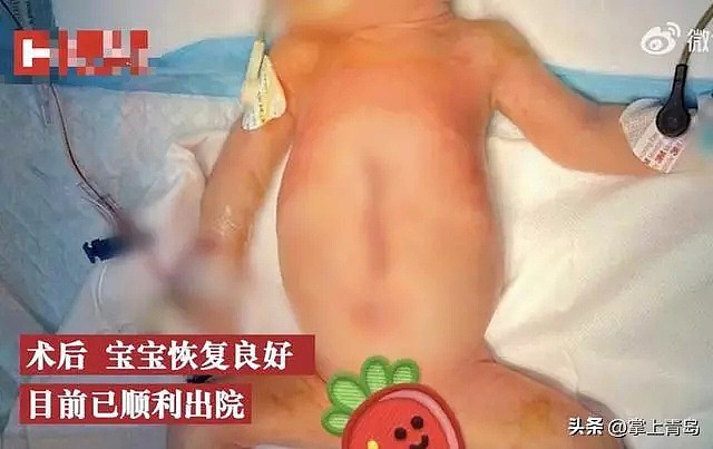 全球罕见！发生概率50万分之一，中国一男婴出生时4手4脚，产妇选择生下来，只因一理由（视频/组图） - 2