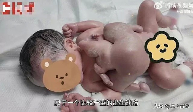 全球罕见！发生概率50万分之一，中国一男婴出生时4手4脚，产妇选择生下来，只因一理由（视频/组图） - 1