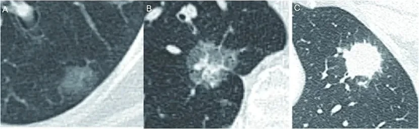 图1 肺结节密度分类，A：磨玻璃结节；B：部分实性结节；C：实性结节 | 图源[16]