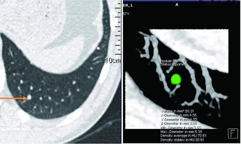 图2 肺结节的容积测量 | 图源[16]