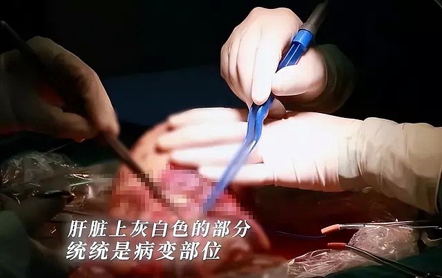 19年一藏族女孩患上虫癌，医生开刀一看，肝脏爬满整整2斤的虫子（组图） - 10