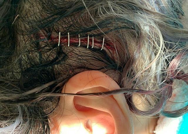 萧亚轩自曝与男友拍MV意外受伤，头部缝六针，呼吁大家尊重生命