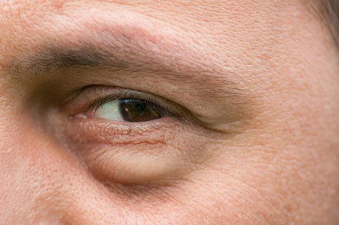 【健康】体内有疾，“眼睛”告知？提醒：若眼睛出现4个异样，尽快检查（组图） - 9