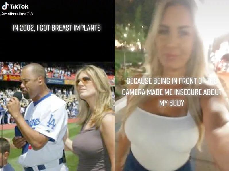 美国女子梅丽莎（Melissa Lima）曾于20年前隆乳植入盐水袋，让自己的胸部看起来更雄伟美观。 （取材自抖音）