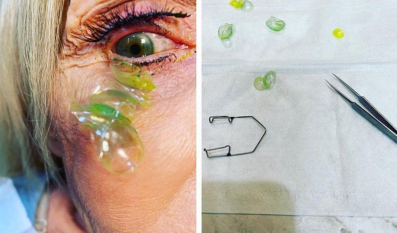 女子连续23天忘记拔隐形眼镜，医师帮忙取出时镜片都因久放变色。 图撷自Instagram
