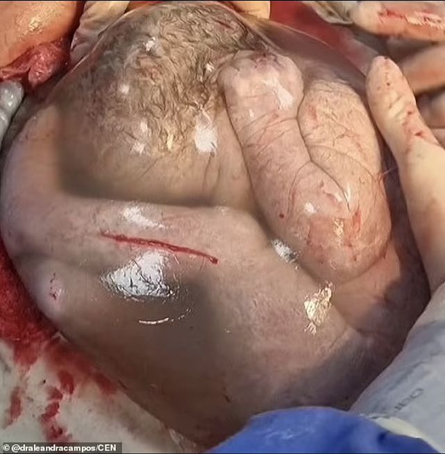 生命神奇！巴西女婴出生时仍裹在羊膜囊内，概率仅8万分之一（组图） - 3
