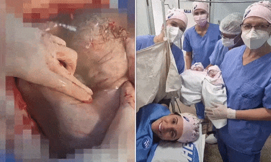 生命神奇！巴西女婴出生时仍裹在羊膜囊内，概率仅8万分之一（组图） - 1